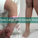 bow legs & knock knees
