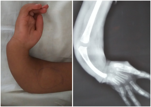 radial club hand