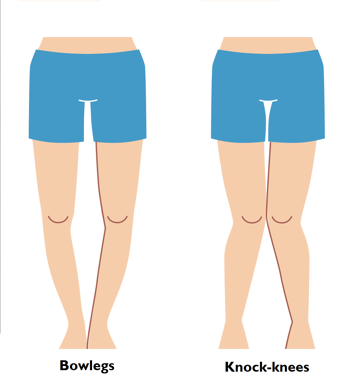 Bow Legs & Knock Knees Treatment in Kolkata, India | Kids Orthopedic