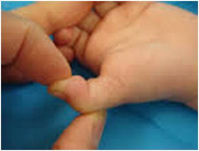 trigger thumb