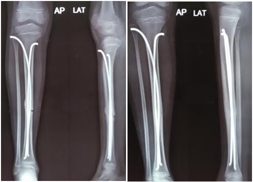 children's fracture