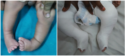 club foot