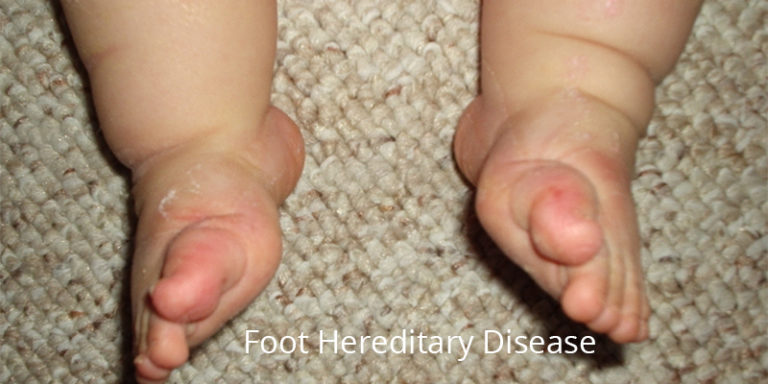 is-club-foot-a-hereditary-disease-kids-orthopedic