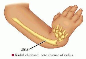 Radial Club Hand Treatment & Management | Kids Orthopedic