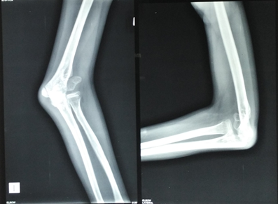 neglected fracture